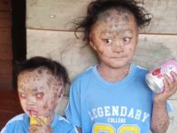 Tolong ! Bocah Kakak – Adik di Mamasa Hidup Memprihatinkan karena Kulit Bersisik