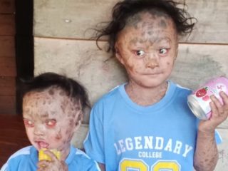 Tolong ! Bocah Kakak – Adik di Mamasa Hidup Memprihatinkan karena Kulit Bersisik